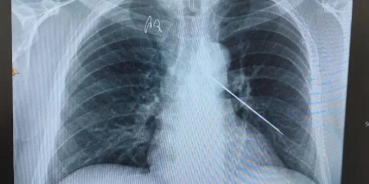 Пациенттің денесінен 10 см сым темір алынды